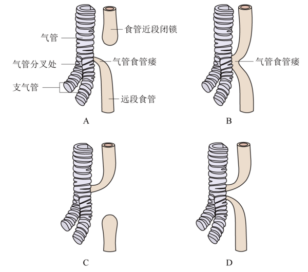 氣管食管瘺