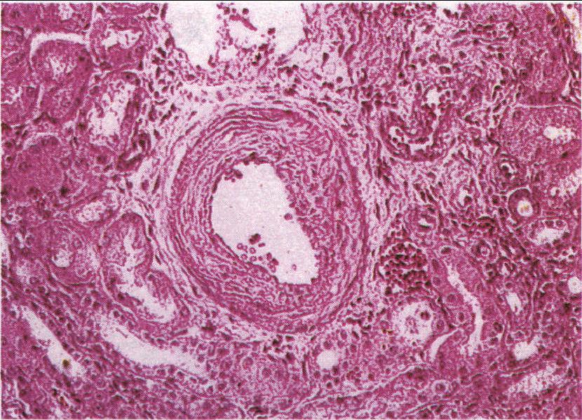 圖1-24 腎間質(zhì)動脈硬化