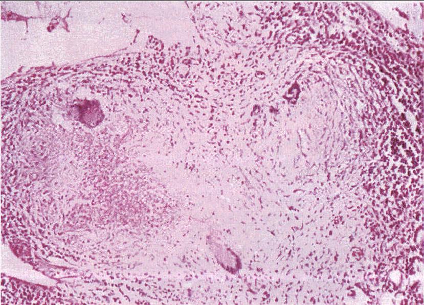 圖1-34 干酪樣壞死